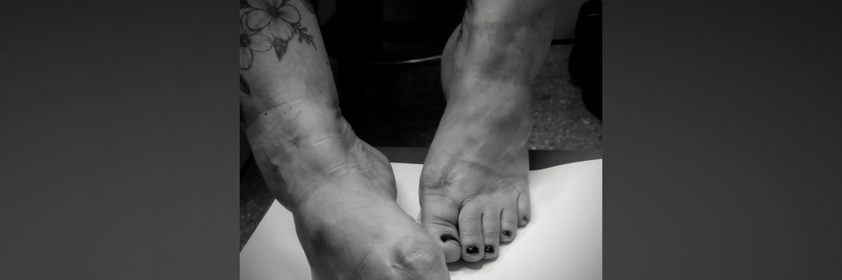 Buby Feet Bunions 💘 cover